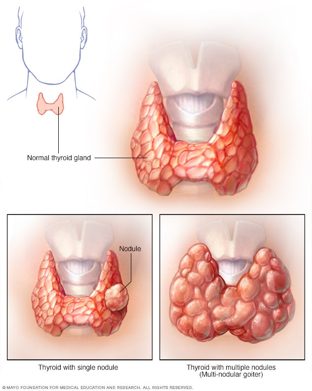 thyroid-nodules.jpg